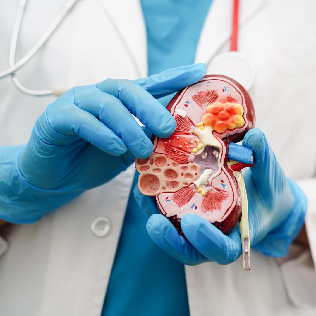 Zdravstveni djelatnik u plavim rukavicama drži anatomski model bubrega s prikazom bubrežnih kamenaca i patoloških promjena.