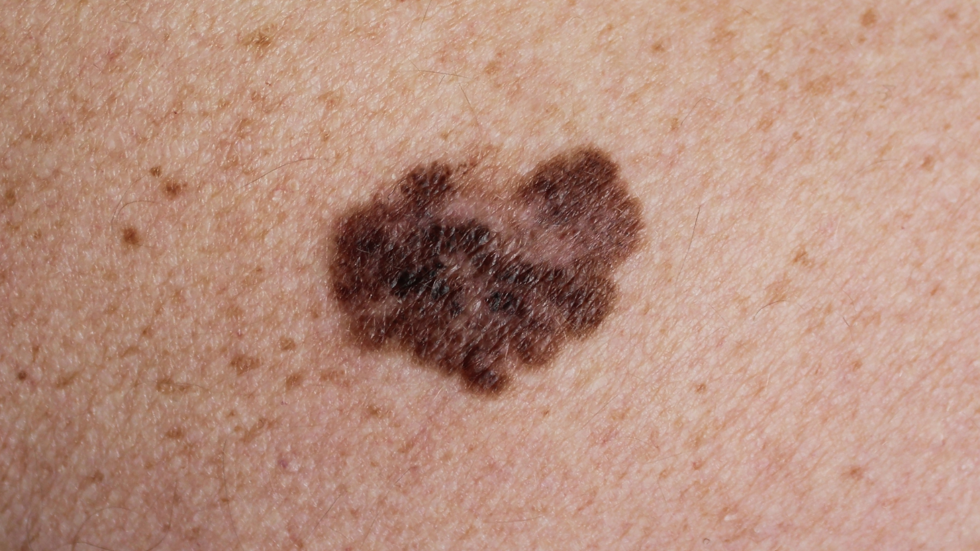 Tamnopigmentirana, nepravilna mrlja asimetričnih rubova i neujednačene boje na koži, okružena sitnim pjegicama.