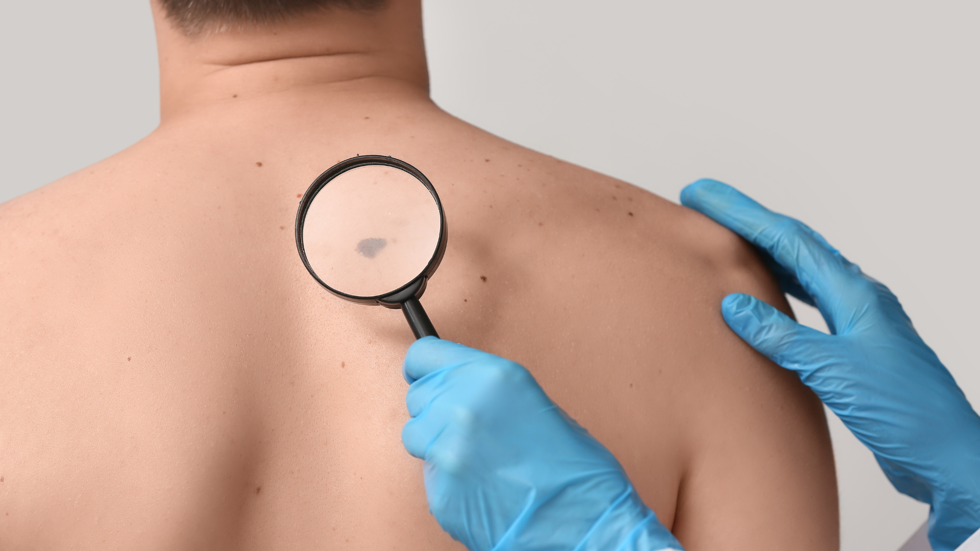 Dermatolog u plavim rukavicama povećalom pregledava tamni madež na leđima pacijenta.