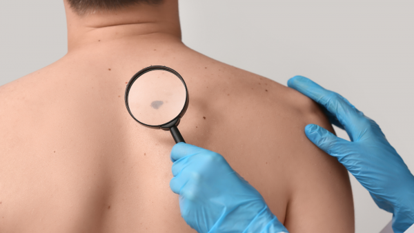 Dermatolog u plavim rukavicama povećalom pregledava tamni madež na leđima pacijenta.