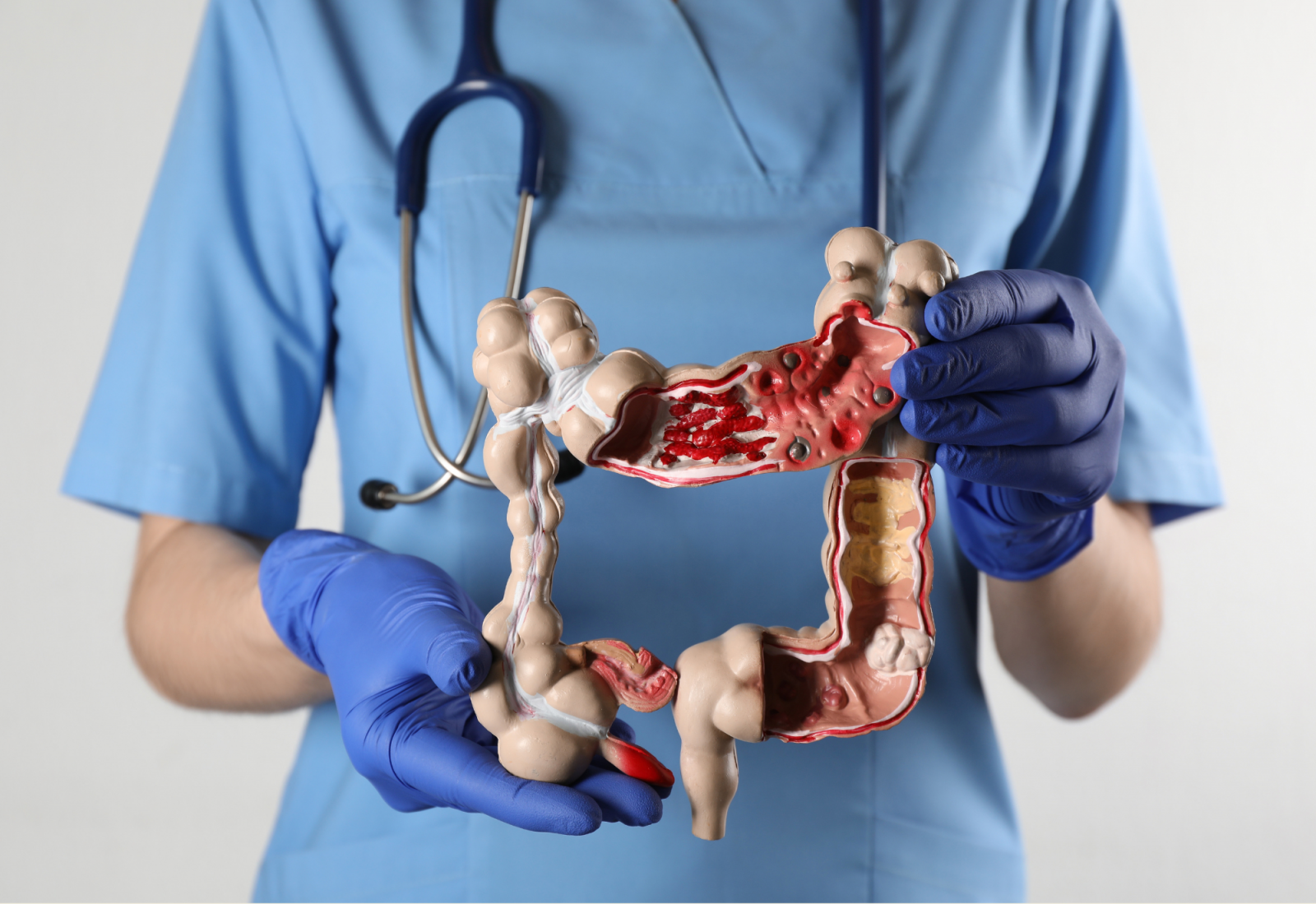 Osoba u plavoj medicinskoj uniformi i ljubičastim rukavicama drži model ljudskih crijeva, s primjetnim crvenim lezijama na unutarnjim dijelovima.