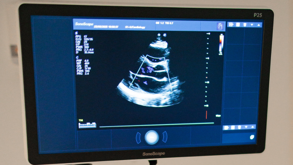 Zaslon SonoScape aparata prikazuje ehokardiogram – ultrazvuk srca s Doppler bojama i tehničkim parametrima u medicinskom okruženju.