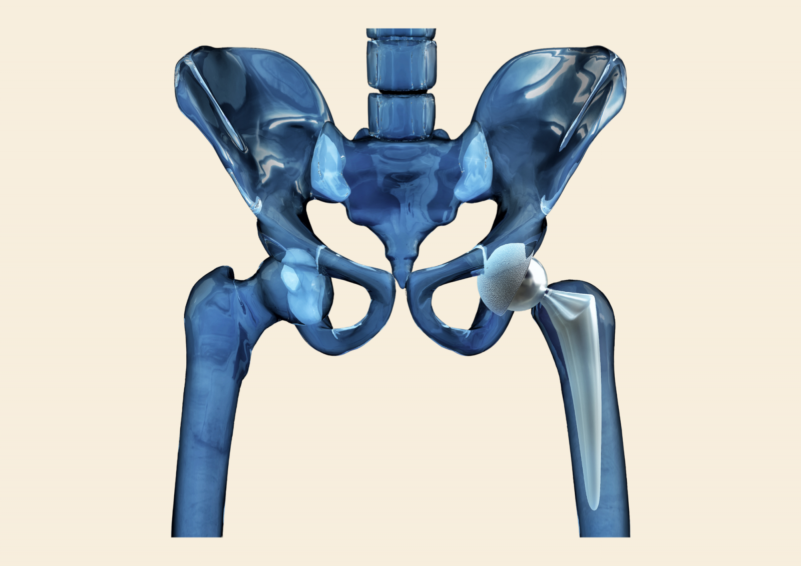 3D prikaz zdjelice s prirodnim lijevim kukom i ugrađenim umjetnim kukom na desnoj strani, s metalnom femoralnom protezom i acetabularnom čašicom.